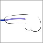 Silicone Dilator Set - obrazek 3
